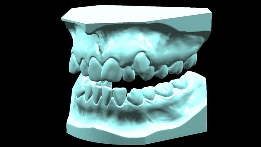 3D Dentistry 3D Scan Sample